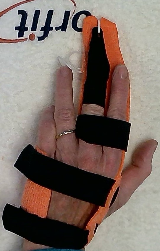 Dorsal view of orthosis